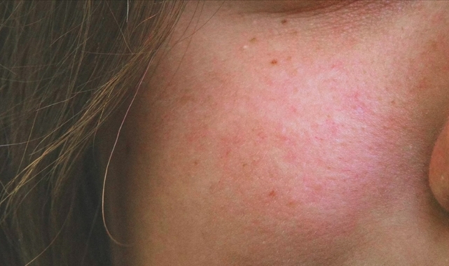 Gül hastalığı açık tenlilerde daha çok görülüyor