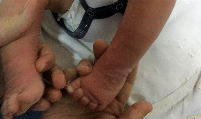 Doğuştan çarpık ayak tedavi edilecek