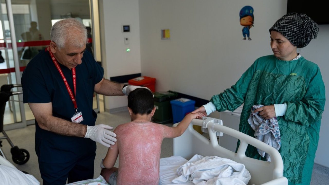 Güneşte 4 saat kalan çocuk, ikinci derece yanıkla hastanelik oldu